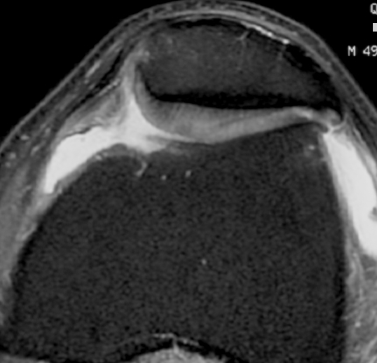Patella Tilt Moderate OA MRI